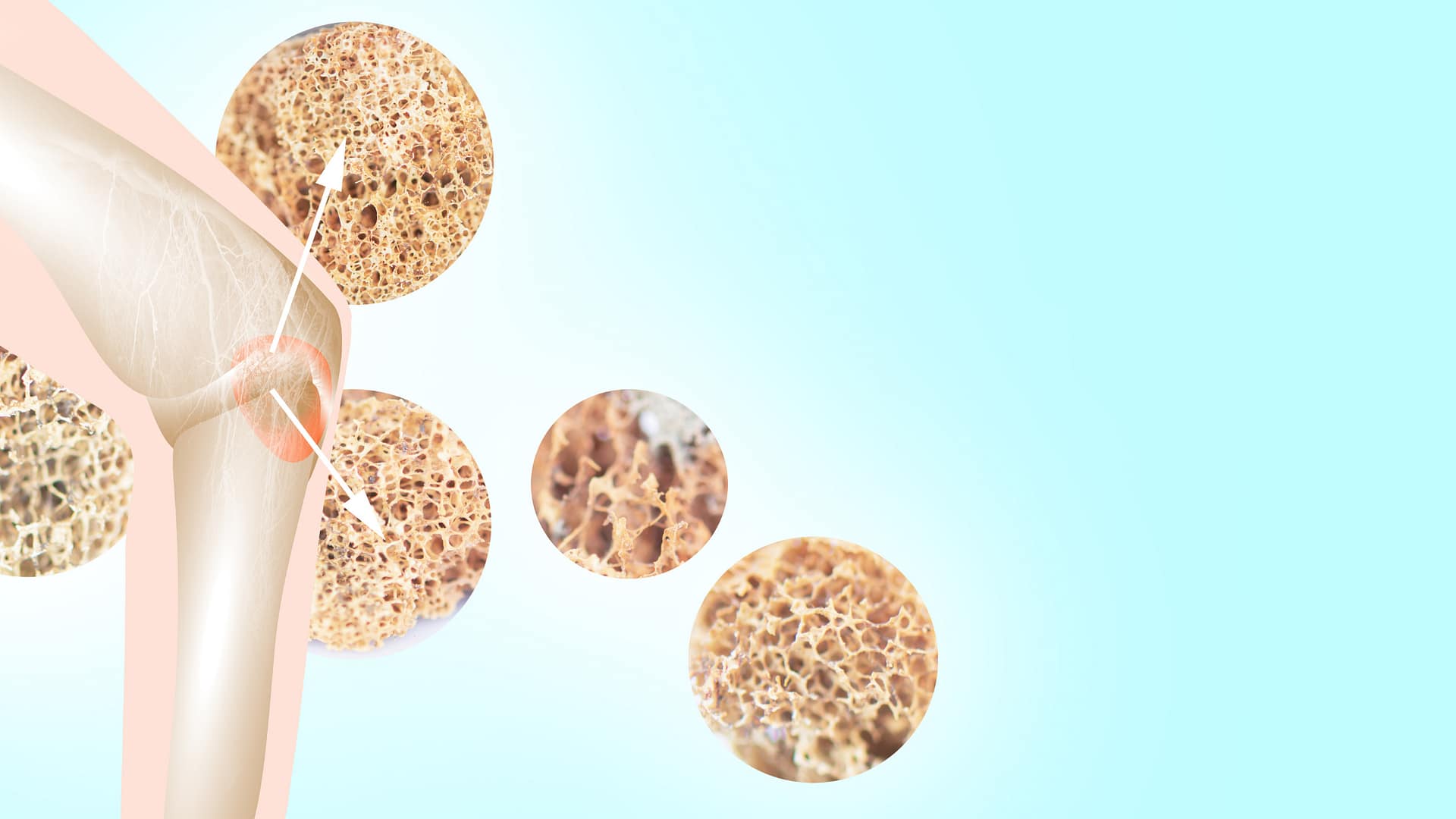 Utrata gęstości kości